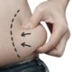 Common Liposuction Myths