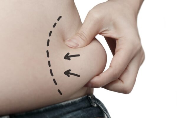 Common Liposuction Myths